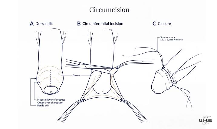 Holmium laser enucleation of the prostate HoLEP